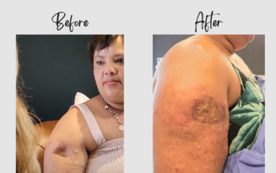 Aesthetic Reconstruction in 3 hours by Dr Ansua Steyn