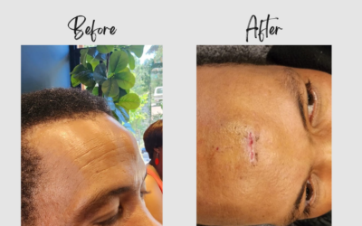 Transformative February: Elroy Rollins’ Lipoma