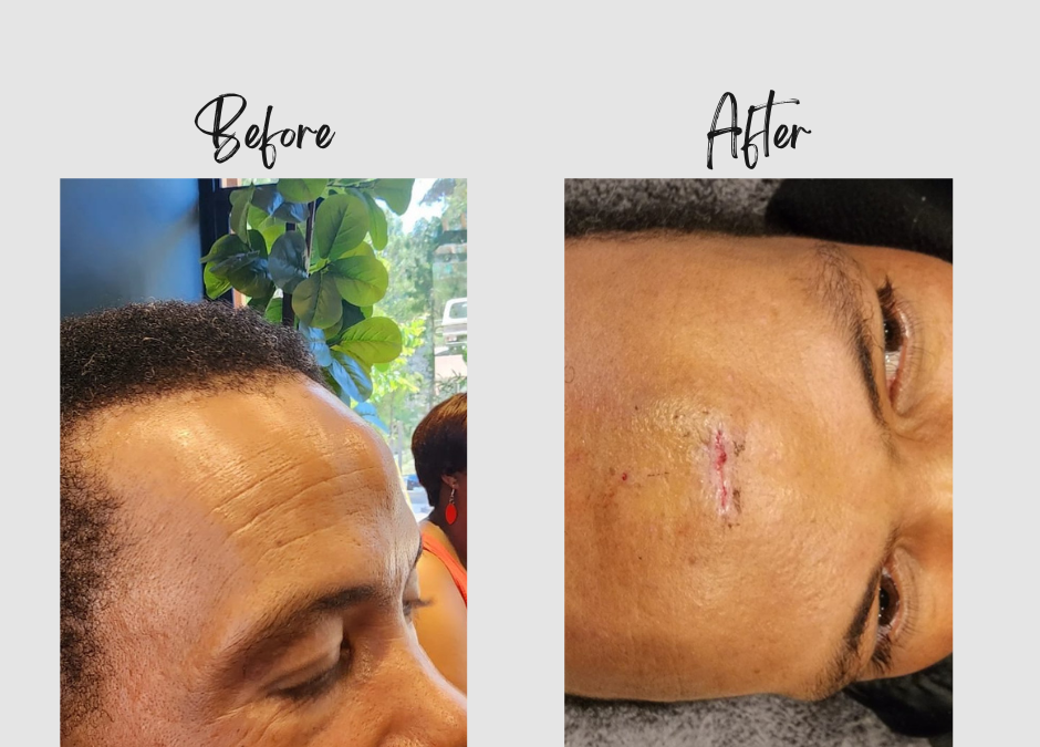 Transformative February: Elroy Rollins’ Lipoma