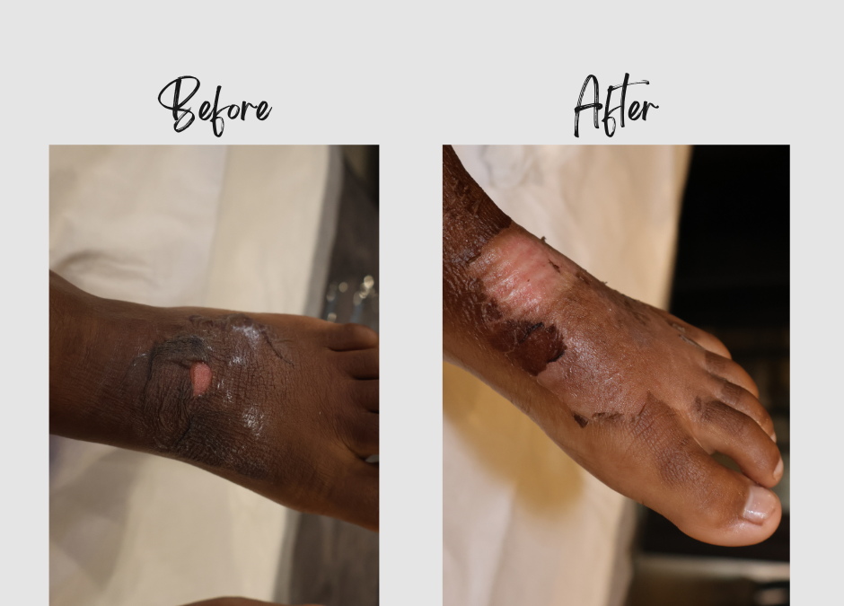 A young girl named Ava receiving burn treatment from Dr. Ansua Steyn at the Dr. Ansua Foundation.