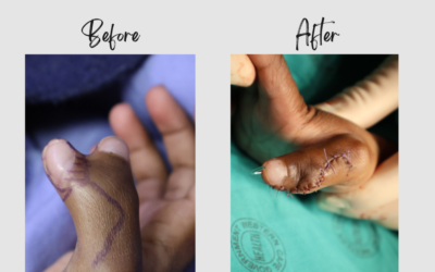 Thumbs Up for the Dr. Ansua Foundation