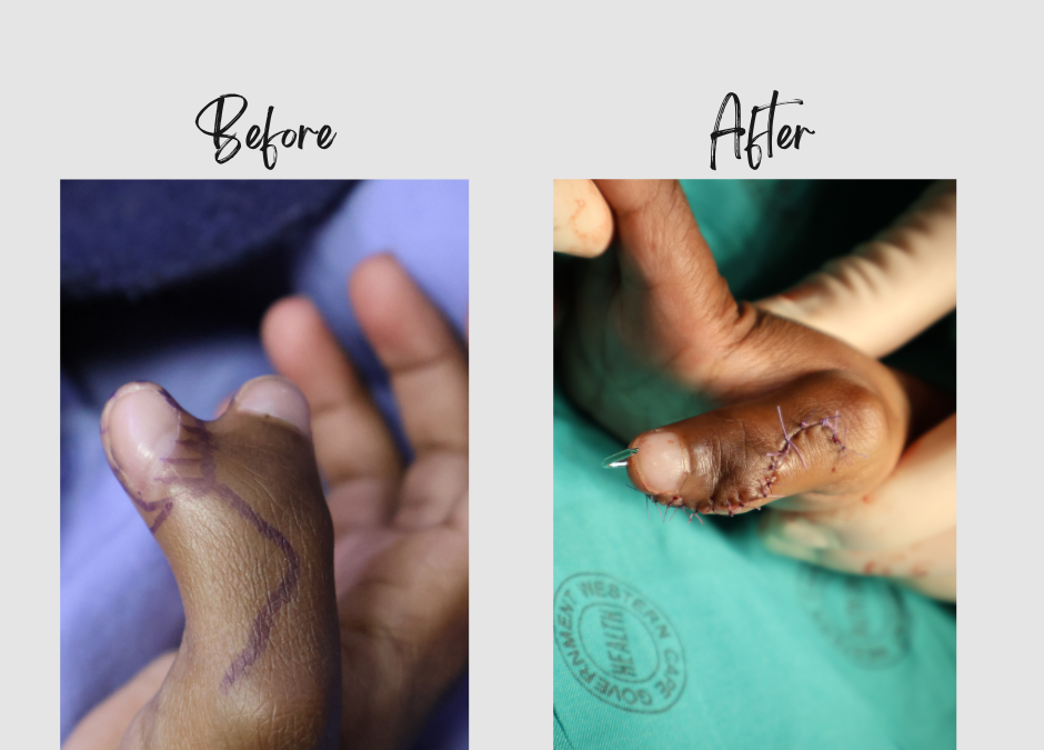 Transforming Lives: Dr. Ansua Foundation's Success in Polydactyly Correction Surgery