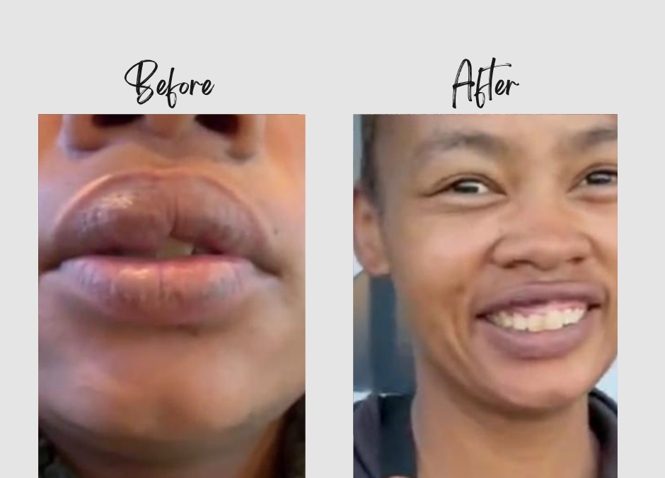 Discover Carryn’s life-changing experience with the Dr Ansua Foundation. Learn how reconstructive surgery gave her a new beginning, restoring her confidence and hope.