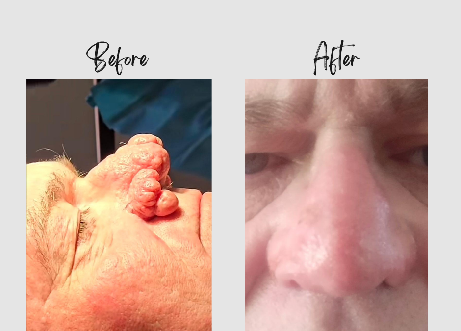 Before and after images of rhinophyma treatment showing nose transformation. Laser treatment for rhinophyma helps reduce blood vessel visibility. Dr. Ansua performing a consultation on rhinophyma management.