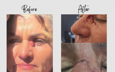 Rowina’s Courageous Battle with Skin Cancer