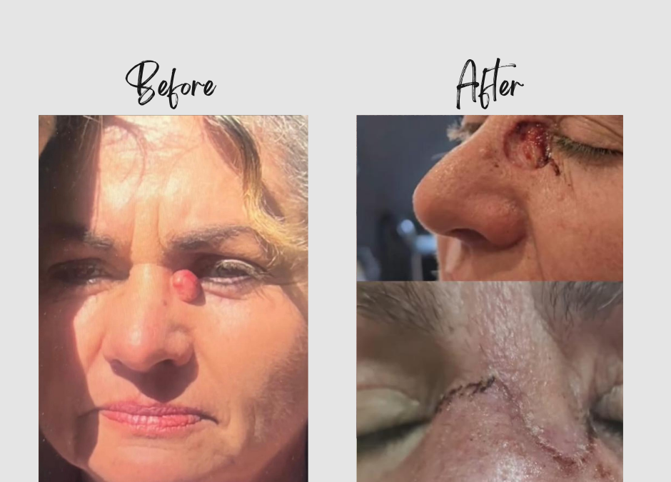 Nico’s Lipoma and Cyst Removal – March Patient of the Month | Dr. Ansua Foundation